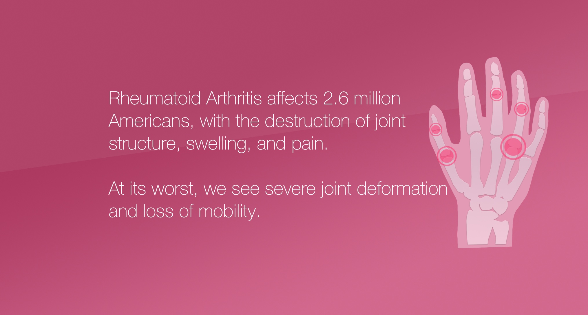 Rheumatoid Arthritis